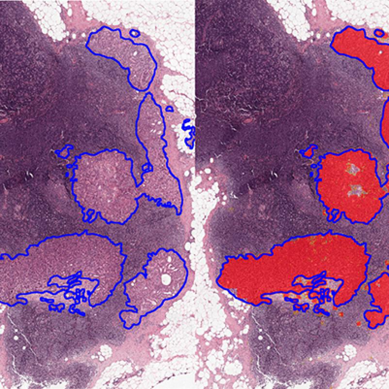 Kunstmatige intelligentie - AI - digitale pathologie
